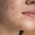 Pele do rosto com acne