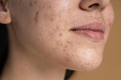 Pele do rosto com acne