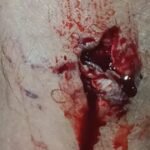 Perna ferida por mordidas de cães