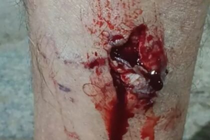 Perna ferida por mordidas de cães