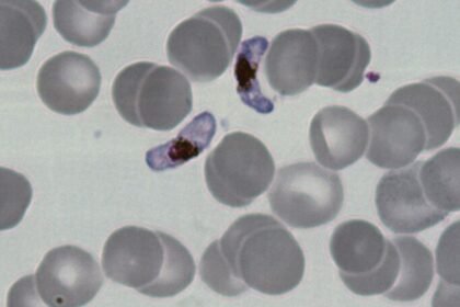 Glóbulos vermelhos infectados pelo parasita da malária vistos ao microscópio