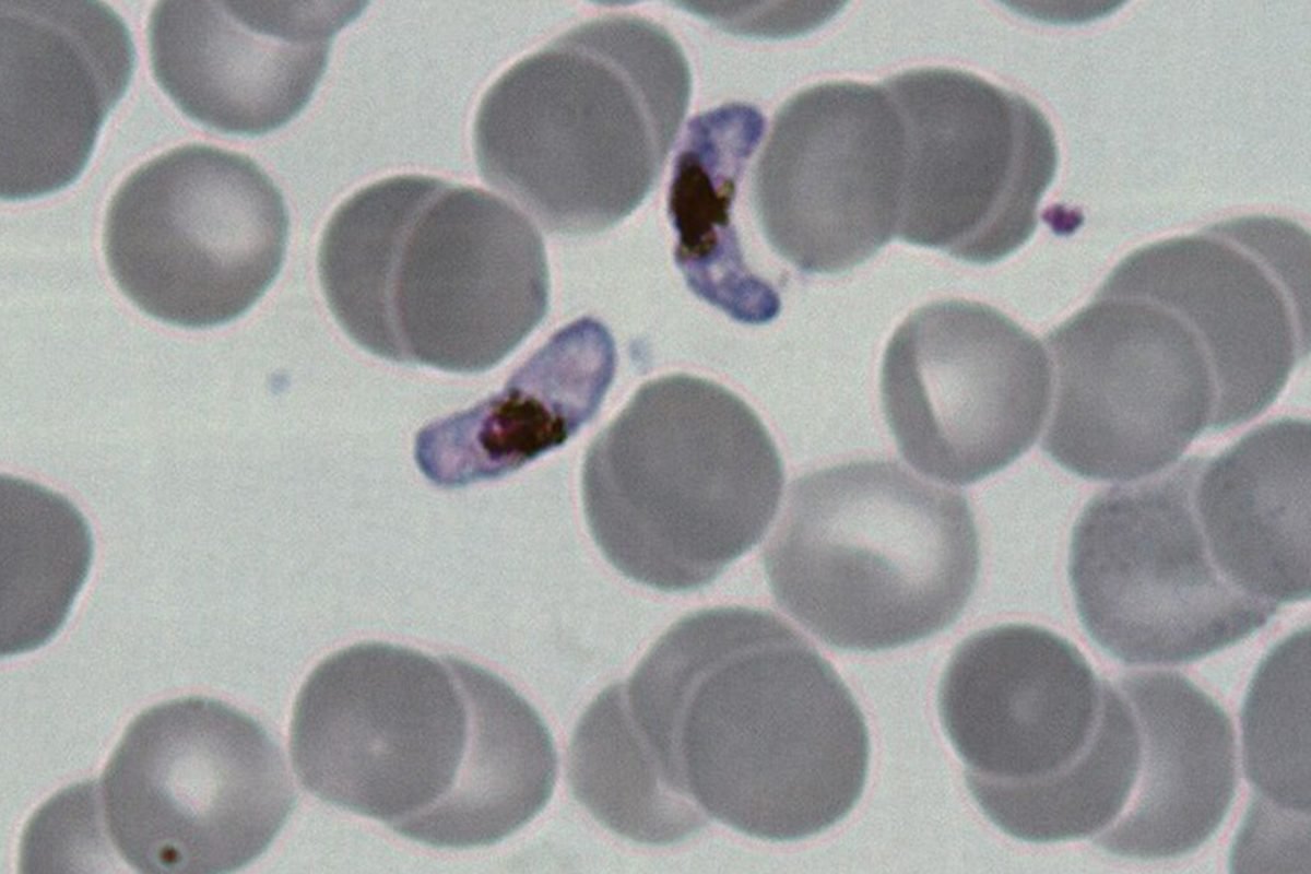 Glóbulos vermelhos infectados pelo parasita da malária vistos ao microscópio